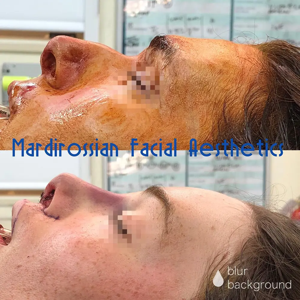 70926852_3586553374691890_8847368295997767680_o (1) Forehead Contouring Before and After Pictures McLean, VA