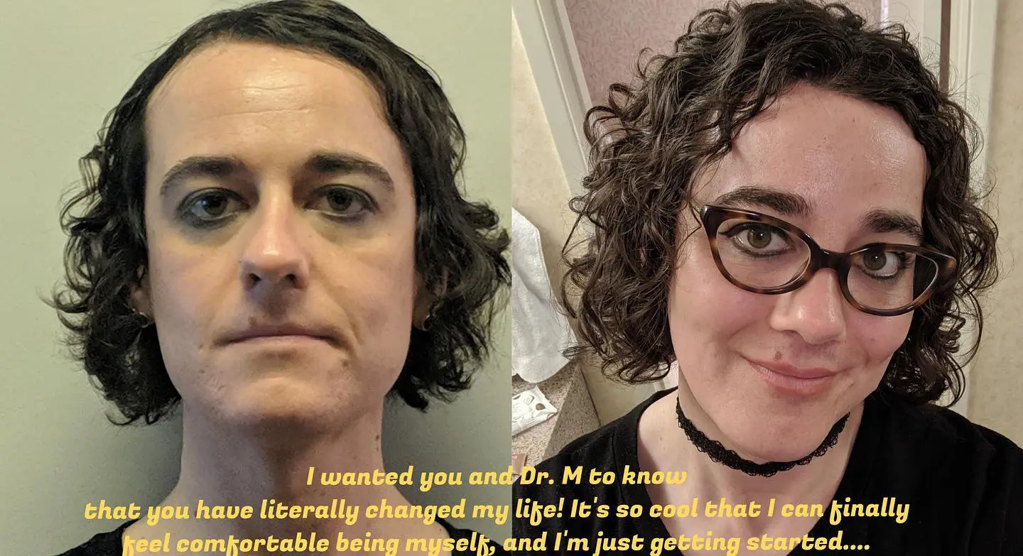 64655885_3290456627634901_3010860666786414592_o (1) Smile Lift Before and After Pictures McLean, VA