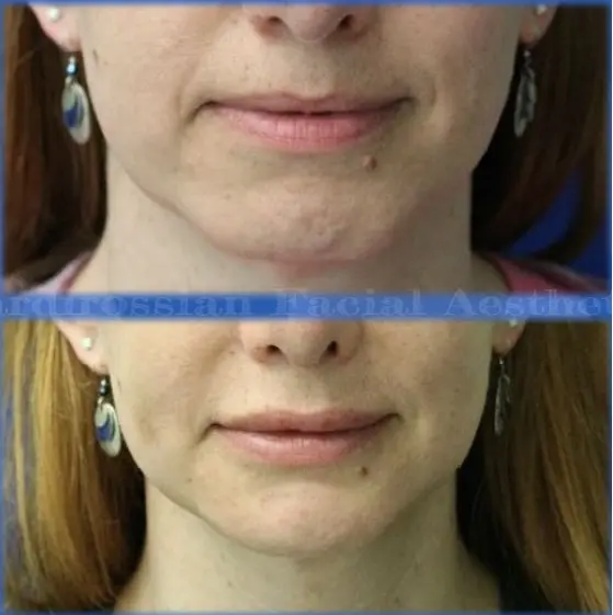 EF Chin Contouring and Augmentation with Lip Augmentation Collage (2) Chin Augmentation Before and After Pictures McLean, VA