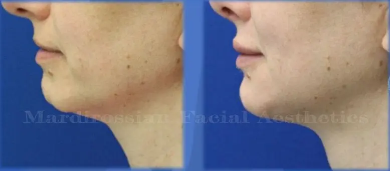 EF Chin Contouring with Augmentation and Lip Implants Collage Chin Augmentation Before and After Pictures McLean, VA