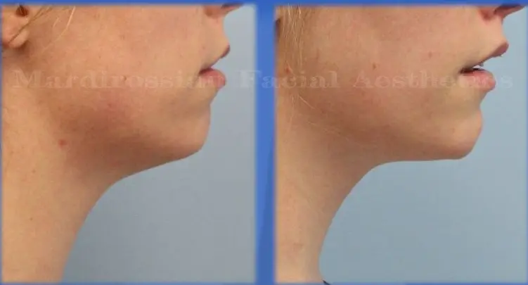 SF Chin Augmentation Collage Chin Augmentation Before and After Pictures McLean, VA