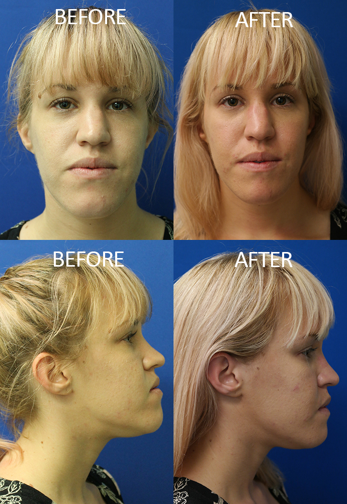 Cheek Implants Surgery Jupiter & West Palm Beach FL