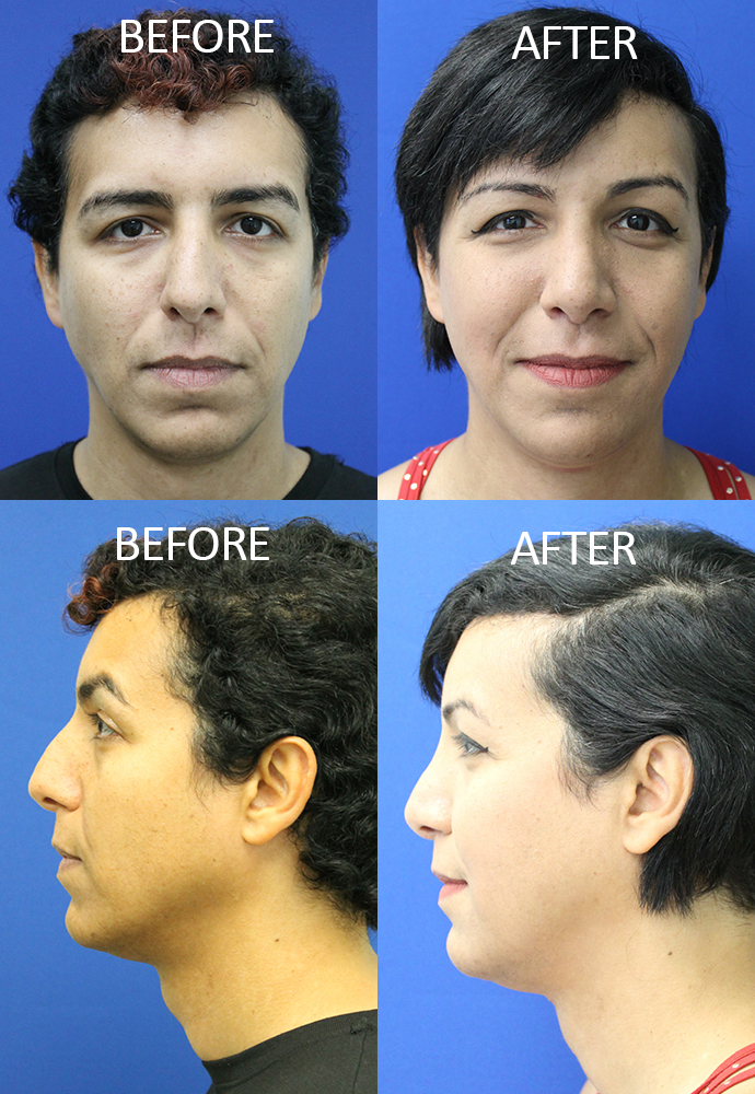 Chin Implant Surgery & Chin Reduction Procedure (FFS)