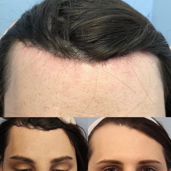 Forehead Contouring Before and After Pictures West Palm Beach, FL