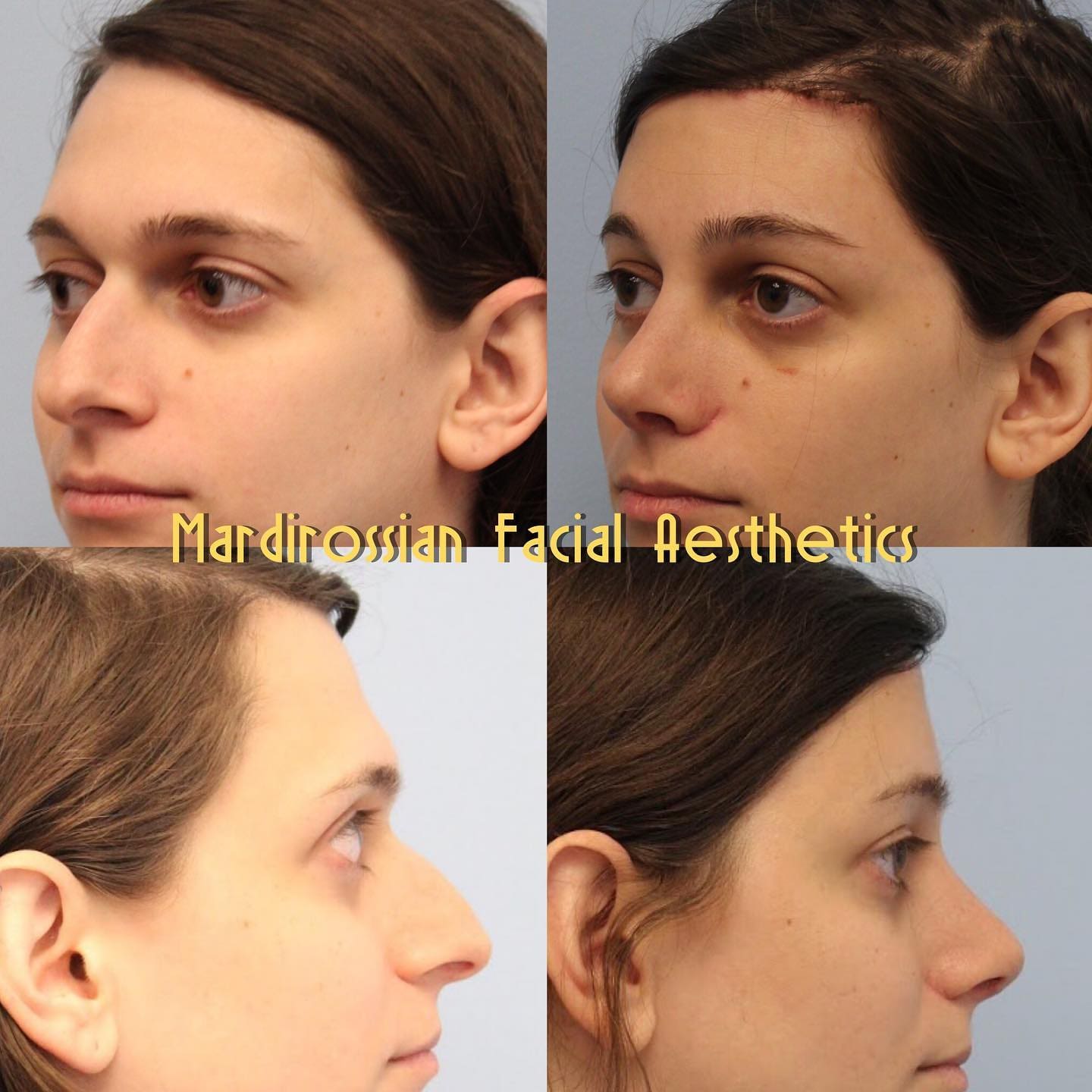 Rhinoplasty Before and After Pictures McLean, VA