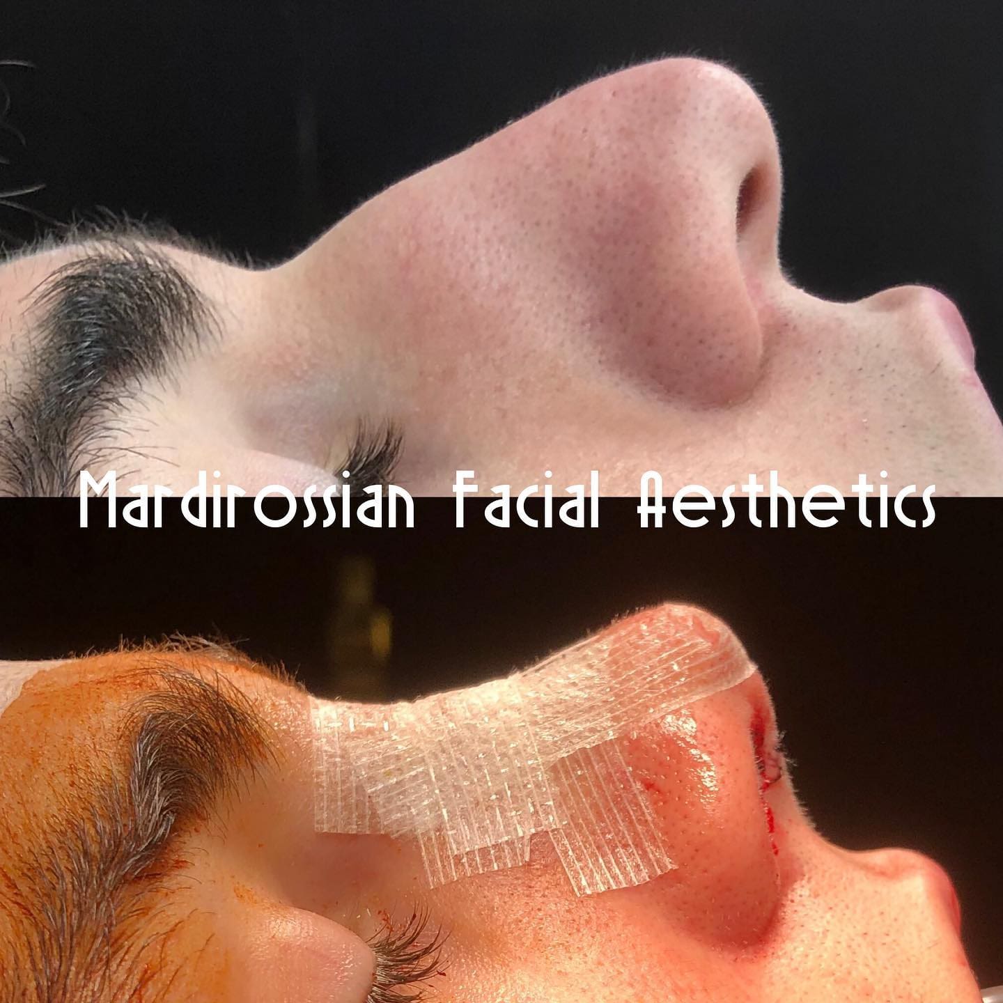 Rhinoplasty Before and After Pictures McLean, VA