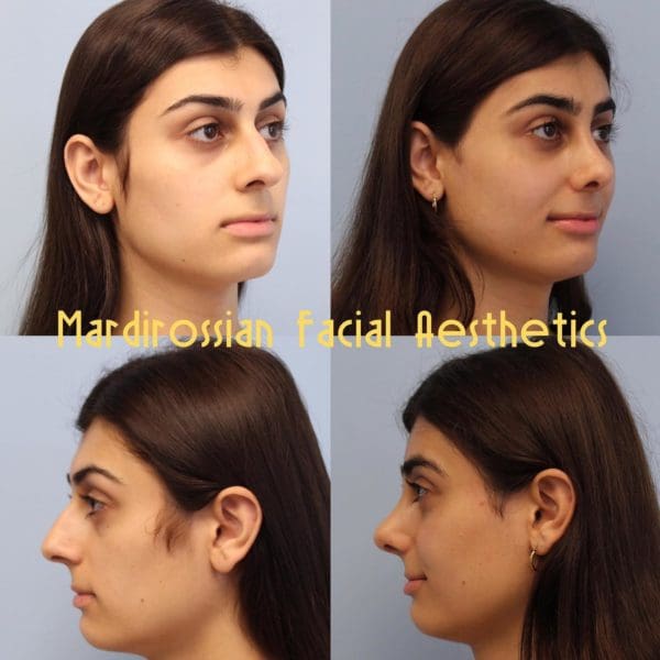 Rhinoplasty Before and After Pictures West Palm Beach, FL
