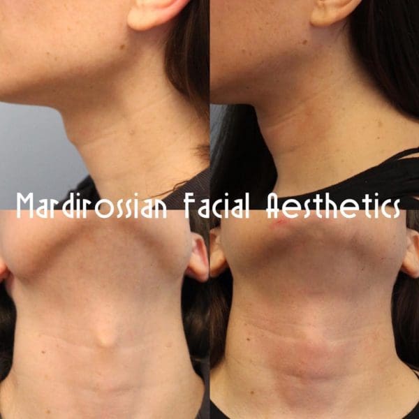 Facial Feminization Surgery (FFS) Before and After Pictures West Palm Beach, FL
