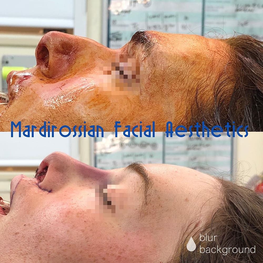 Forehead Contouring Before and After Pictures McLean, VA