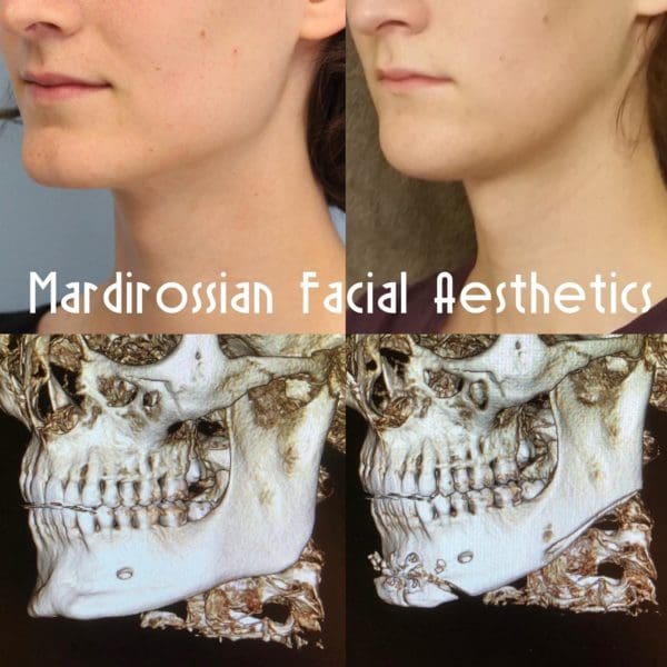 Facial Feminization Surgery (FFS) Before and After Pictures West Palm Beach, FL