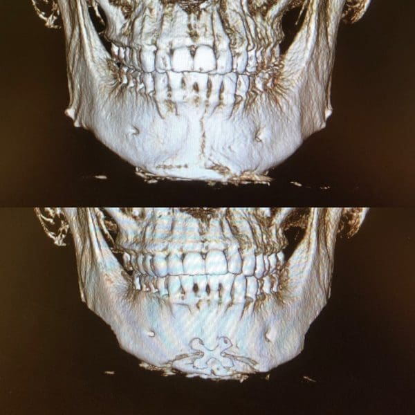 Mandible Contouring in West Palm Beach, FL