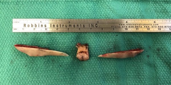 Mandible Contouring in West Palm Beach, FL