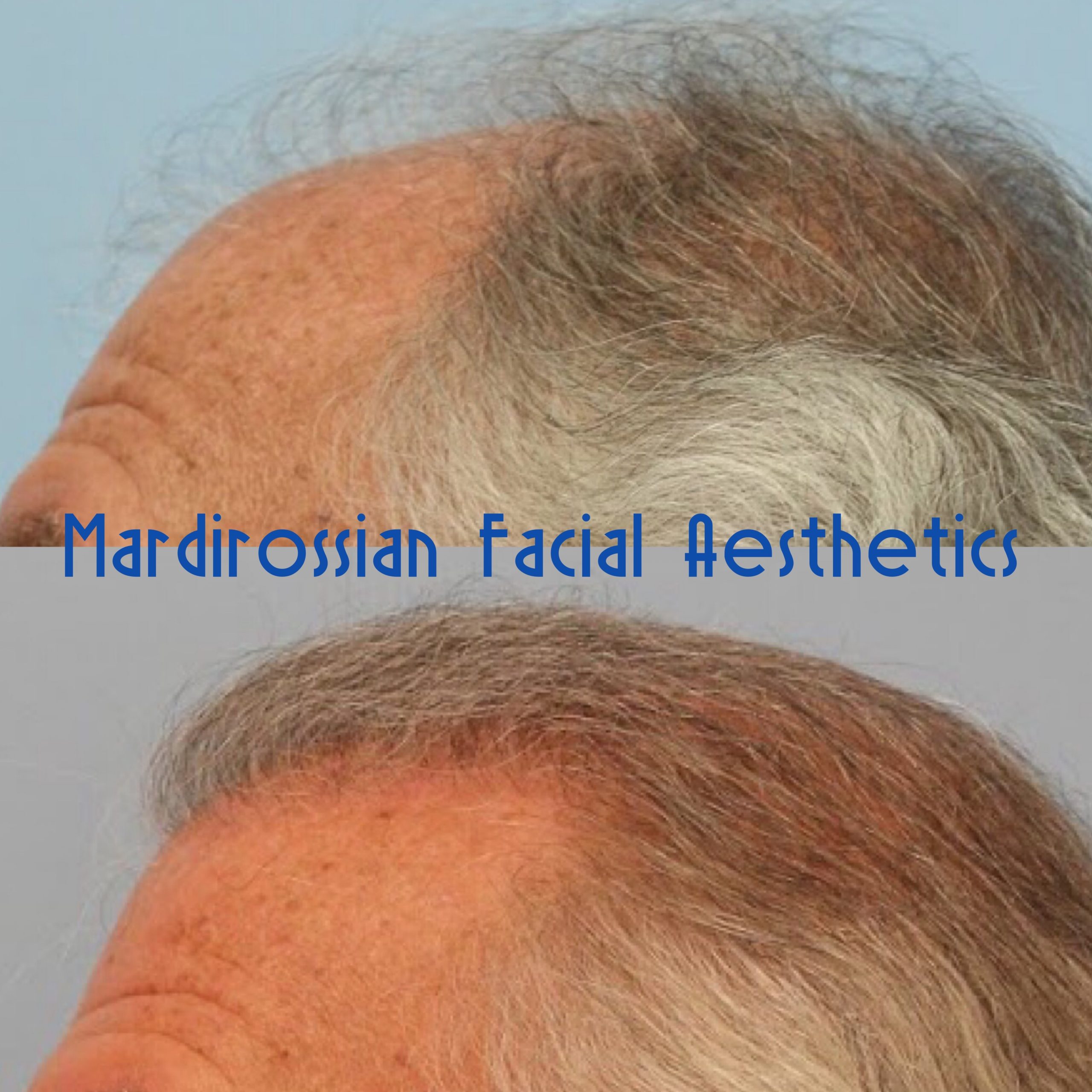 Hair Transplant Before and After Pictures McLean, VA