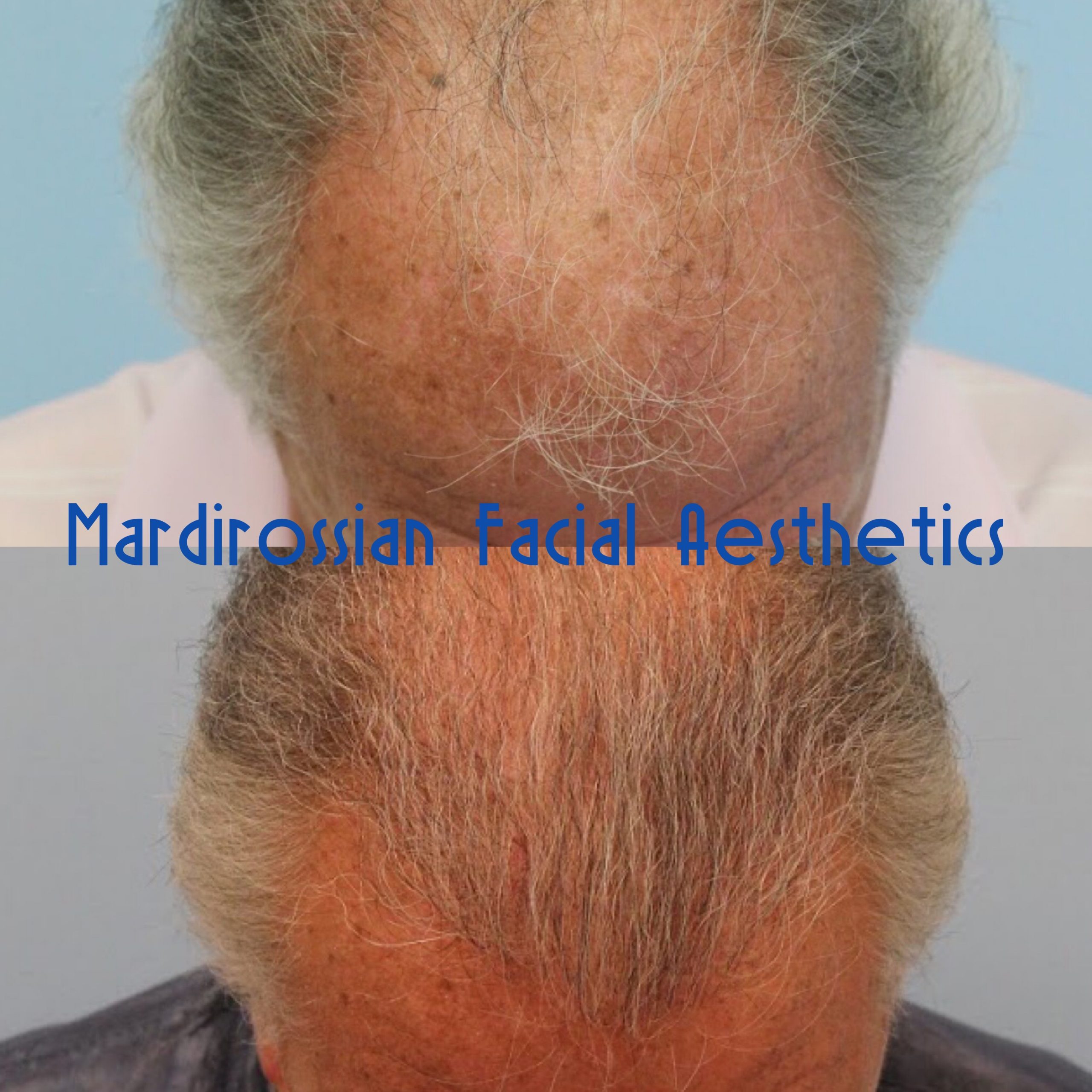 Hair Transplant Before and After Pictures McLean, VA