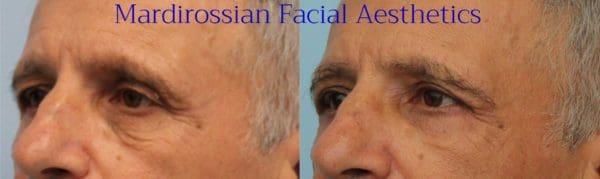 Blepharoplasty Before and After Pictures West Palm Beach, FL