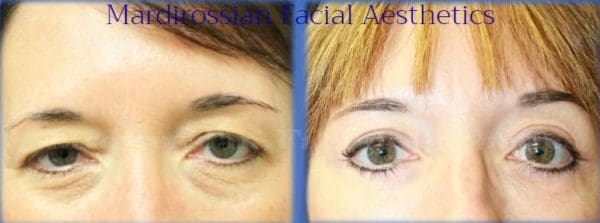 Blepharoplasty Before and After Pictures West Palm Beach, FL