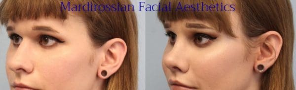 Cheek Implants Before and After Pictures West Palm Beach, FL