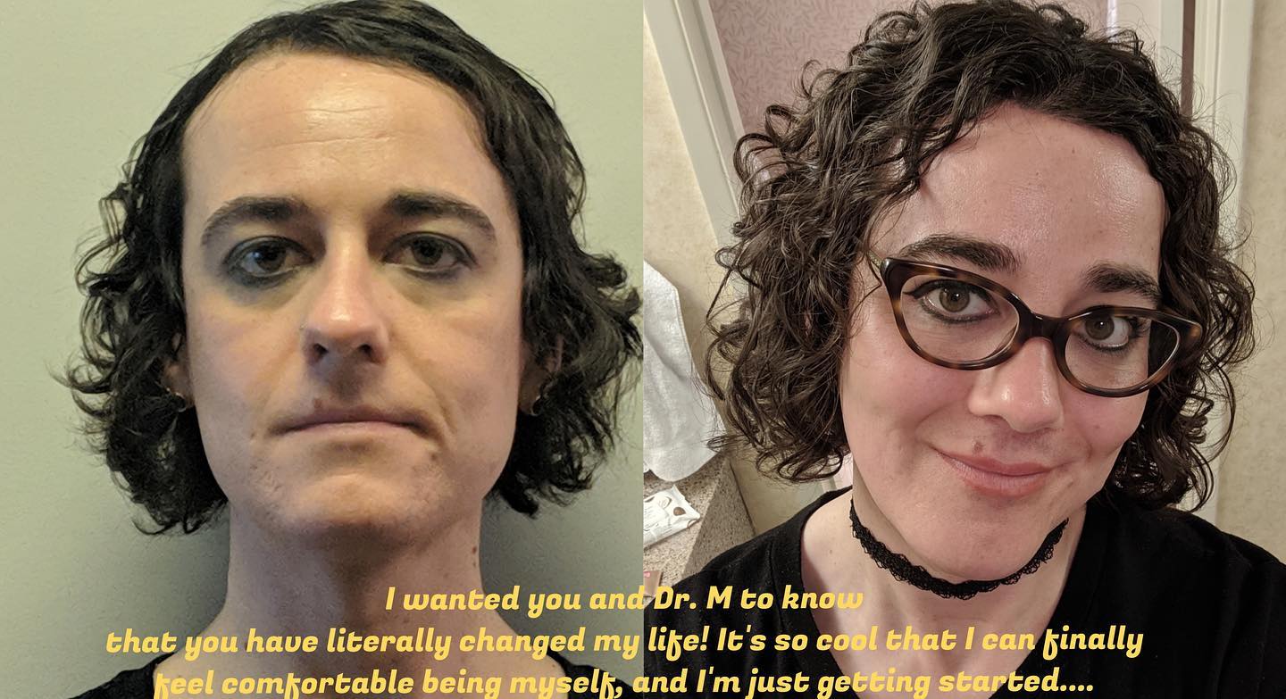 Smile Lift Before and After Pictures McLean, VA