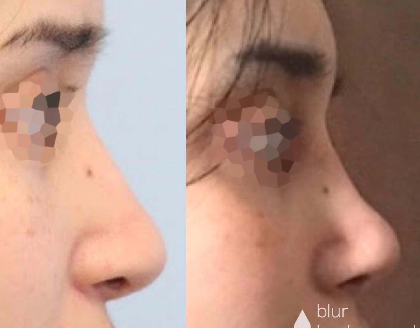 Rhinoplasty Before and After Pictures McLean, VA