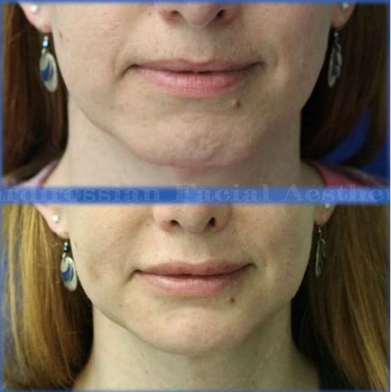 Chin Augmentation Before and After Pictures McLean, VA