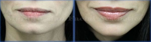 Chin Augmentation Before and After Pictures West Palm Beach, FL