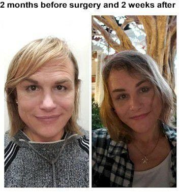Smile Lift Before and After Pictures McLean, VA