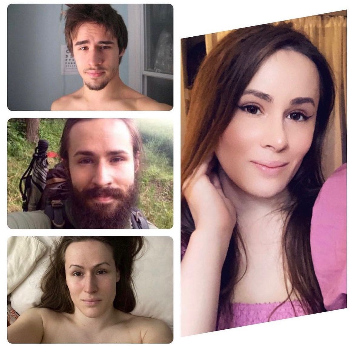 Facial Feminization Surgery (FFS) in McLean, VA