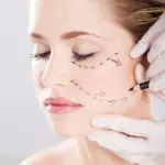 Facelift Surgery