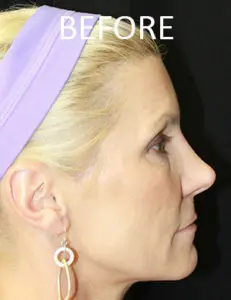 Mardirossian Facial Aesthetics Before and After Pictures