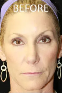 Mardirossian Facial Aesthetics Before and After Pictures