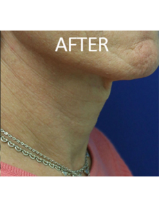 Mardirossian Facial Aesthetics Before and After Pictures