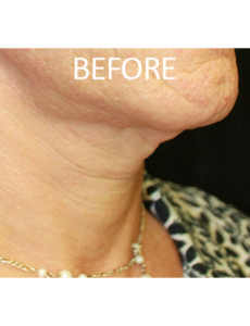 Mardirossian Facial Aesthetics Before and After Pictures