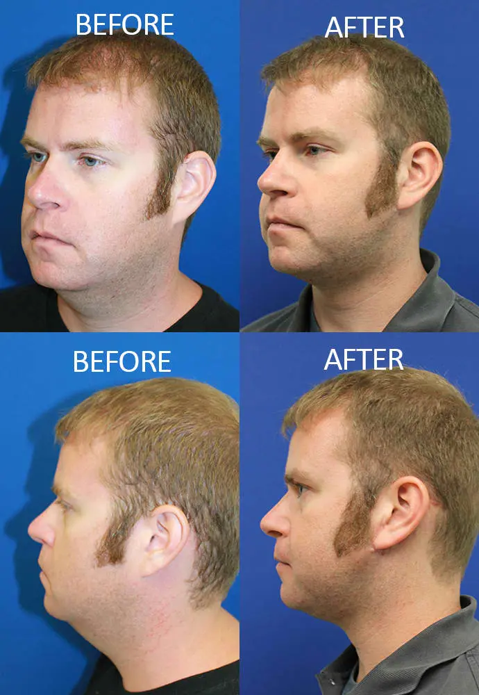 Face & Neck Lift