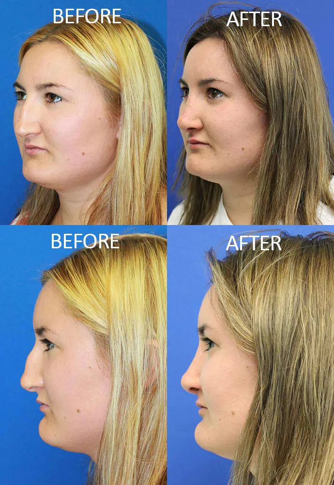 Rhinoplasty