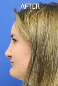 Mardirossian Facial Aesthetics Before and After Pictures