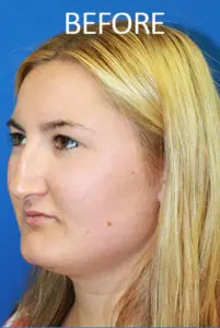 Mardirossian Facial Aesthetics Before and After Pictures