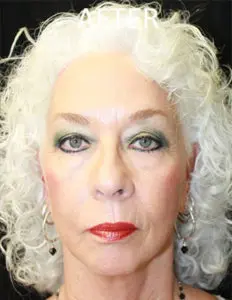 Mardirossian Facial Aesthetics Before and After Pictures