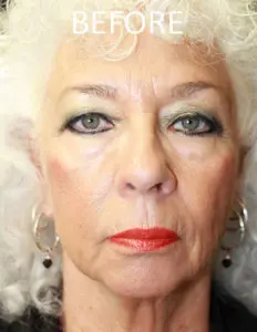 Mardirossian Facial Aesthetics Before and After Pictures