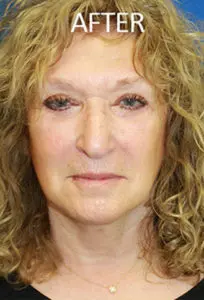 Mardirossian Facial Aesthetics Before and After Pictures