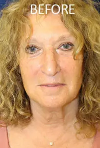 Mardirossian Facial Aesthetics Before and After Pictures