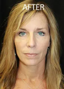 Mardirossian Facial Aesthetics Before and After Pictures