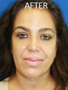 Mardirossian Facial Aesthetics Before and After Pictures