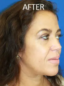 Mardirossian Facial Aesthetics Before and After Pictures