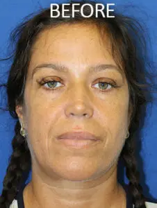 Mardirossian Facial Aesthetics Before and After Pictures