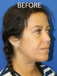 Mardirossian Facial Aesthetics Before and After Pictures