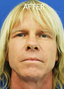 Mardirossian Facial Aesthetics Before and After Pictures