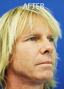 Mardirossian Facial Aesthetics Before and After Pictures