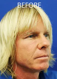 Mardirossian Facial Aesthetics Before and After Pictures