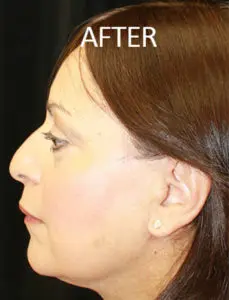 Mardirossian Facial Aesthetics Before and After Pictures