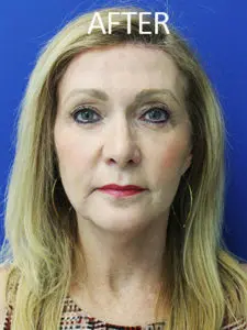 Mardirossian Facial Aesthetics Before and After Pictures